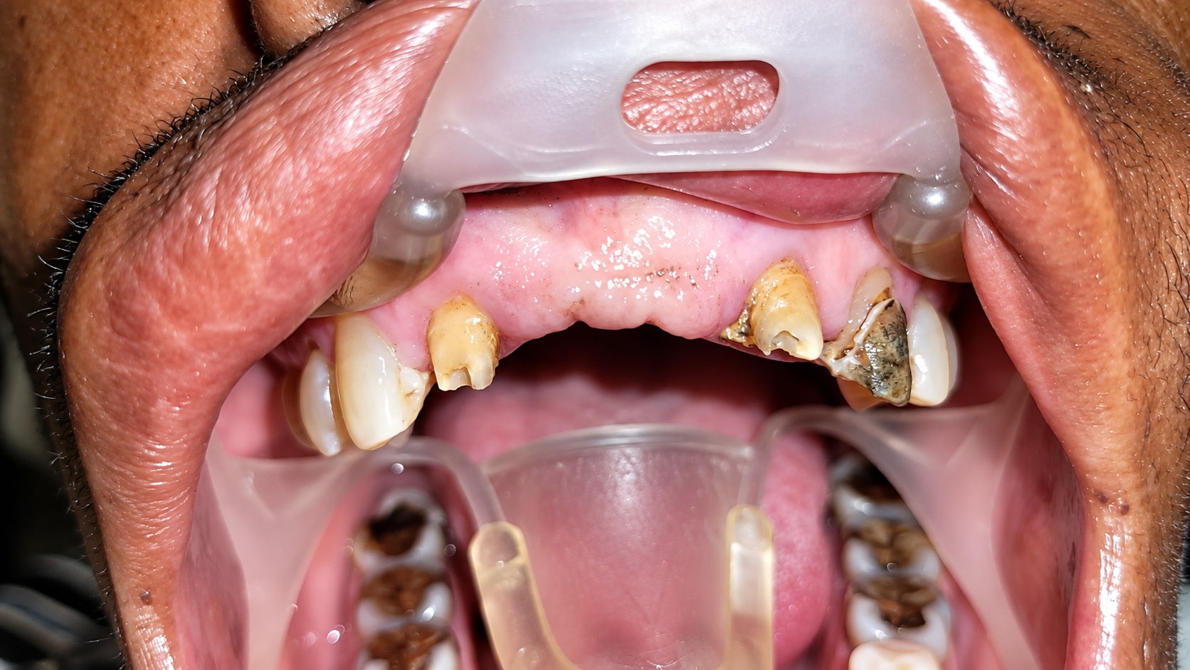 Before dental treatment